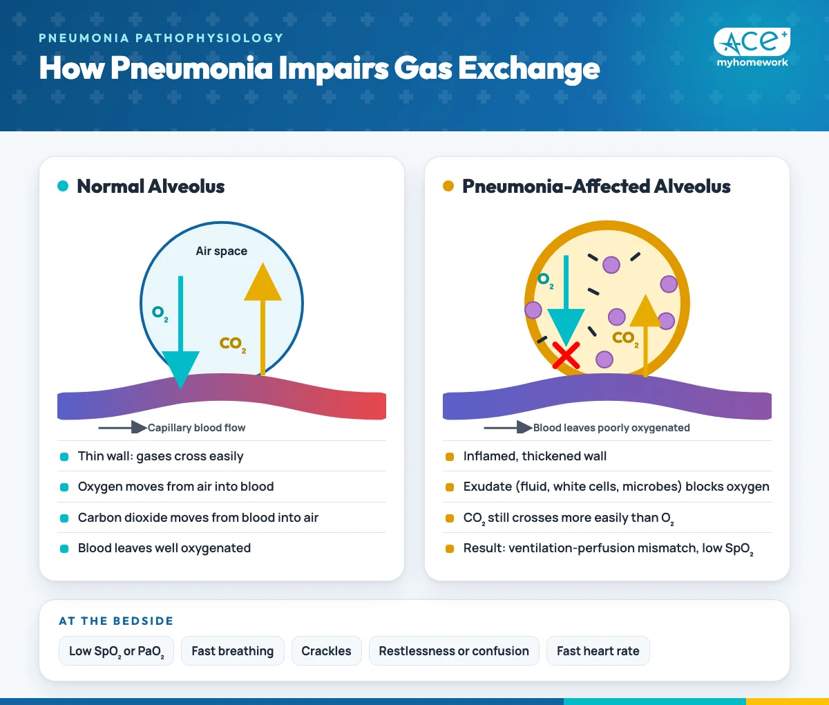 Side-by-side diagram of a normal alveolus with oxygen moving into the capillary and carbon dioxide moving out, and a pneumonia-affected alveolus filled with exudate that blocks oxygen transfer